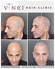 Top 5 Best Non-Surgical Hair Loss Treatments - Vinci Hair Clinic