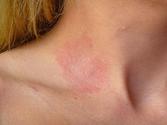 Herbalmax Inc. : How to Use Herbal Formula For Skin allergy ?