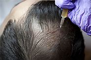 Does PRP Stop Hair Loss?