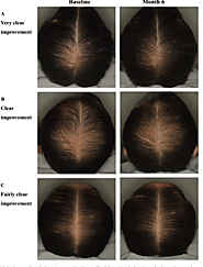 Can Adenosine Reverse Hair Loss