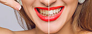Know how to treat week teeth? – Dental Wellness Center
