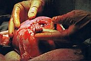 abortus