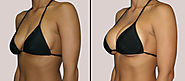 Breast Augmentation Surgery in Delhi | Breast Implants (Mammaplasty) Cost in India