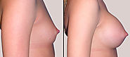 Best Breast Surgeon in Delhi/NCR | Breast Surgery Types Cost and Reviews