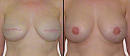 Breast Reconstruction Surgery | Breast Reconstruction Cost in Delhi, India