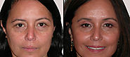 Eyelid Surgery in Delhi | Blepharoplasty Cost in India