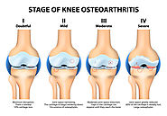 Osteoarthritis treatment Delhi | PRP Therapy for knee pain India