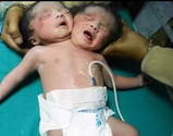 India: Woman Gives Birth to a Two-Headed Baby