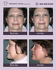 Facelift And Necklift In Atlanta - Dr. Pradeep Sinha