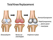 Knee Replacement Implants in Aurangabad | Knee Joint Treatments