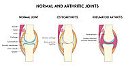 Knee Replacement Surgery Aurangabad | Osteoarthritis Treatment Maharashtra