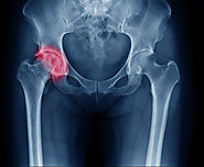 Total Hip Replacement in Aurangabad | Cheapest Hip Replacement Surgery Maharashtra