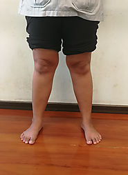 Knock knees|Knee Injury Care Aurangabad|Bow Legs Correction India