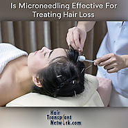 Is Microneedling Effective For Treating Hair Loss? — hairtransplantnetwork