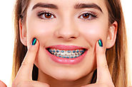 Upkeep Tips for Braces from a Dentist in Laguna Niguel