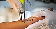 Answering To Your Laser Tattoo Removal Questions!
