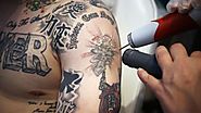 Laser Tattoo Removal Is Quick, Easy and Painless