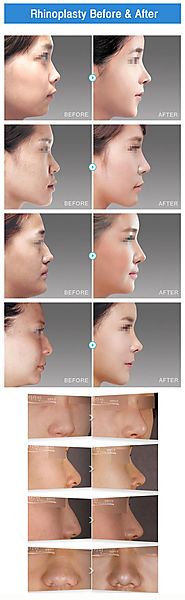 Best Rhinoplasty Surgeon In Korea