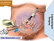 Laparoscopic Surgery in gurgaon | Less Cut, Less Bleeding, More Safe Way