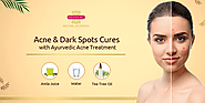 Acne & Dark spots Causes with Ayurvedic Acne Treatment