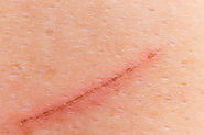First-Aid Tips to a Minor Cut Wound