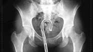Please Don't Stick Stuff Up Your Butt: 16 Strange X-Rays of Things People Have Put Up There