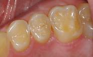 Premolars