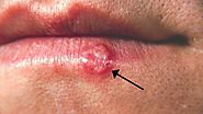 Lysine for Cold Sores - How Do I Use It For My Cold Sore? | Article Alley