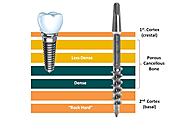 Get Perfect Solution for Missing Tooth with Effective Dental implant Treatment