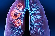 Alternative Treatment For Lung Cancer | AspCares