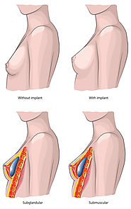 What happens to your nipples during Breast Surgery?