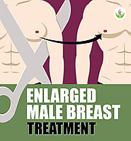 Enlarged Male Breast Treatment