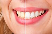 Teeth Whitening: What Are the Options?