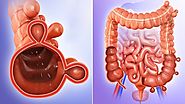 Diverticulitis – Know More About The Stomach Condition | RRMCH