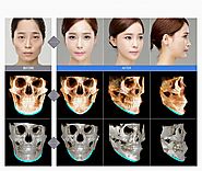 Jaw Surgery Korea, Korean Jaw Reduction Surgery in Seoul, South Korea