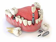 Multiple Teeth Replacement Kochi | Dental Implant Surgery Kerala