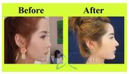 Asia Clinic Nose Augmentation Before And After Photos