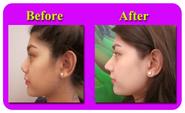 The Best Plastic Surgery Clinic In Thailand