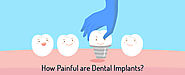 Website at https://www.dentalsphere.in/blog/dental-implants