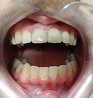 Website at https://www.dentalsphere.in/treatment/tooth-cap-crowns-bridges-pune