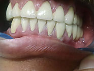 Website at https://www.dentalsphere.in/treatment/tooth-cap-crowns-bridges-pune