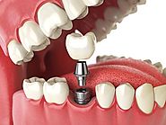 Benefits of Dental Implants that are Hard to Ignore | Posts by Dental Sphere | Bloglovin’