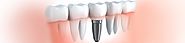 What are Implants & Their Advantages | Dental Implants in Pune, Mukundnagar