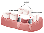 crowns dental lab pa