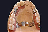 Fixed partial dentures in PA