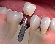 Get Implanted Teeth as Natural Teeth with Dental Implants Flemington Expert Services