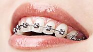 Get the Best Teeth Alignment Treatment Done and have a Nice Smile