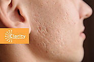 How To Get Rid Of Acne Scars - Clarity MedSpa