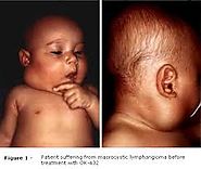 An infant with lymphagioma