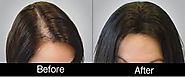 PRP restoring lost hair growth